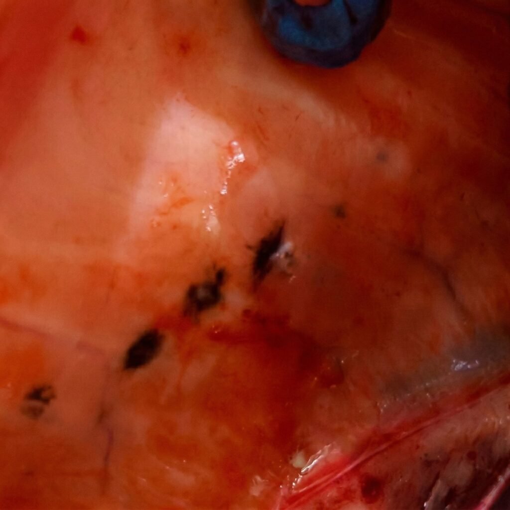 Melanosis in Atlantic salmon.